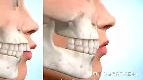 如何知道你的龅牙属于牙性还是骨性?