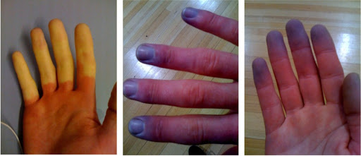 手指惨白没有血色,警惕"雷诺现象"和背后的风湿病!