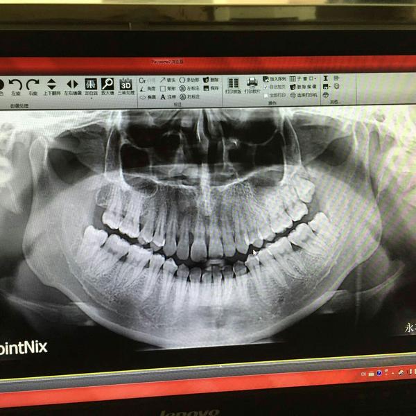 可不可以麻烦你帮我看下我的门牙是牙槽骨萎缩么