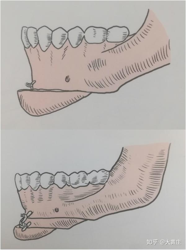 下颌升支矢状劈开截骨术示意图.