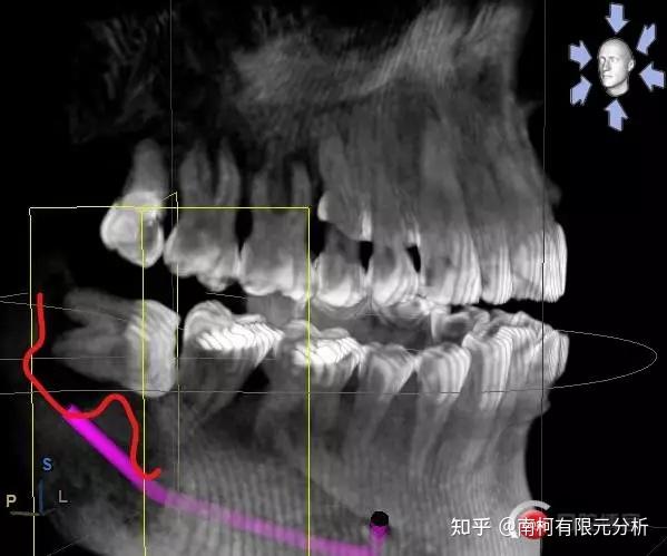 预防下牙槽神经损伤小结