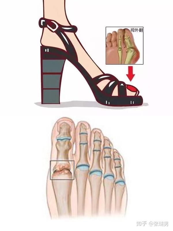 你的足弓还好吗?(天津艾柯特运动康复中心)