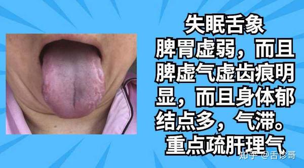 阴虚体质头昏困倦总是忧心忡忡等舌象的分析与感悟