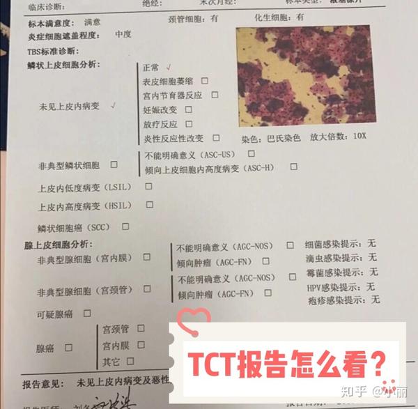 tct报告怎么看