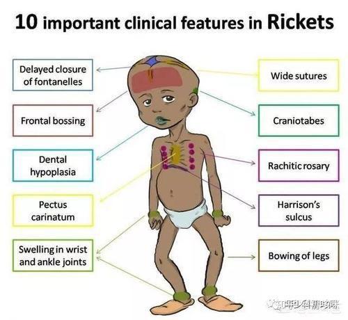 因为佝偻病和缺钙关系密切,所以骨骼的变化是其主要症状,下肢部位常见