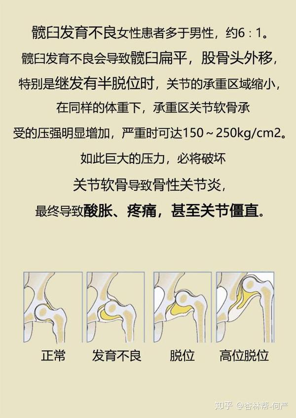 什么是成人髋臼发育不良如何治疗漫画版