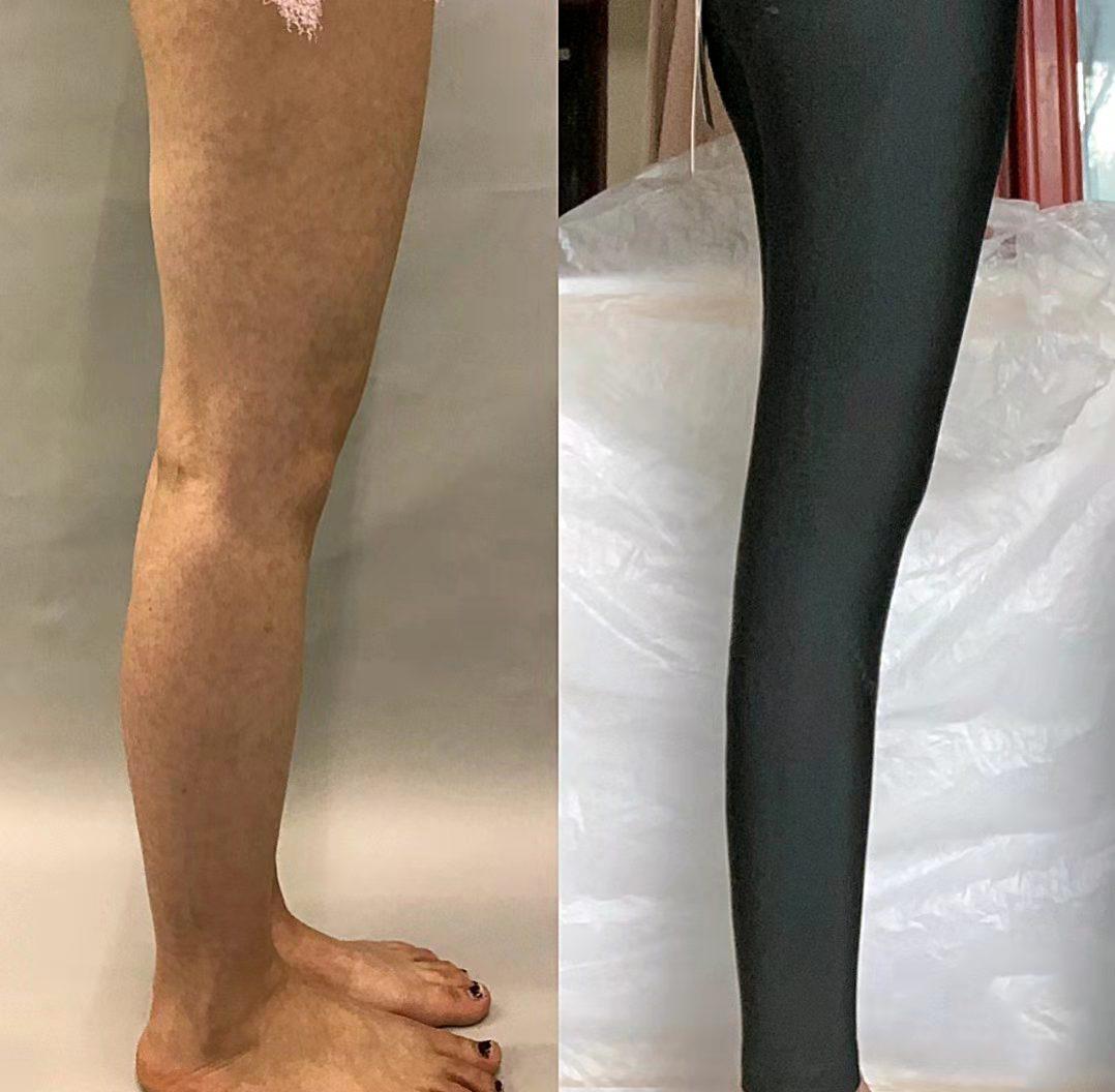 北京小腿吸脂术后60天恢复过程分享