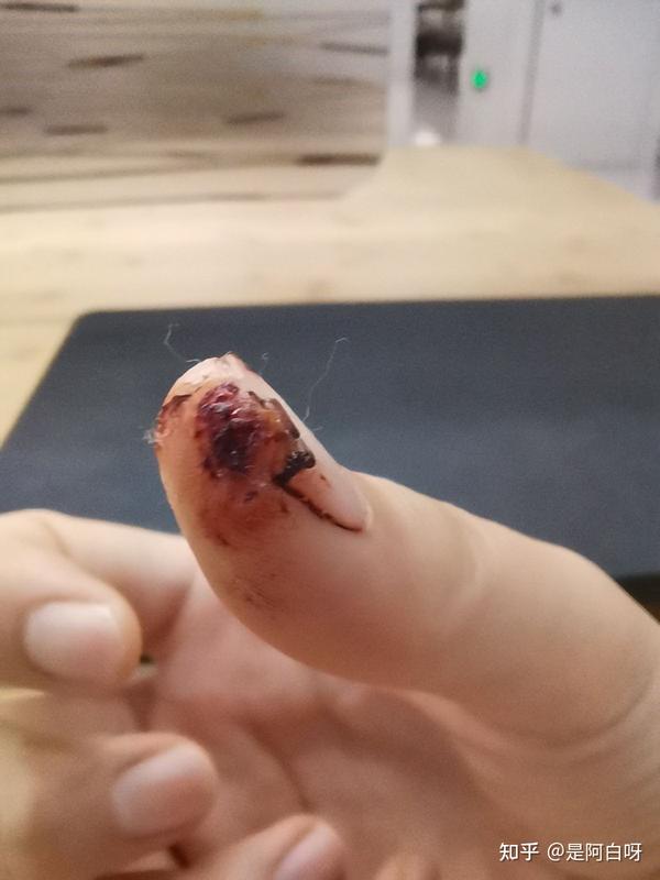 右手大拇指被切下一块后恢复记录皮和肉未贴回持续更新