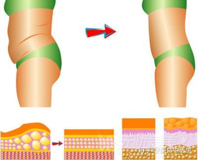 抽脂手术是怎么设计的到底疼不疼会不会皮肤松弛