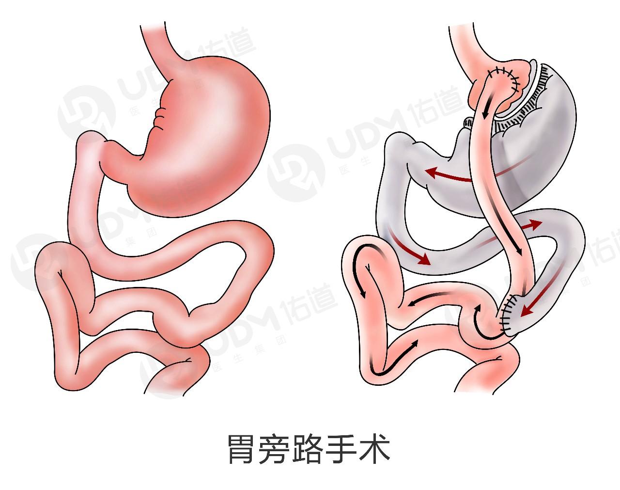 2型糖尿病的首选治疗方案,胃转流手术!