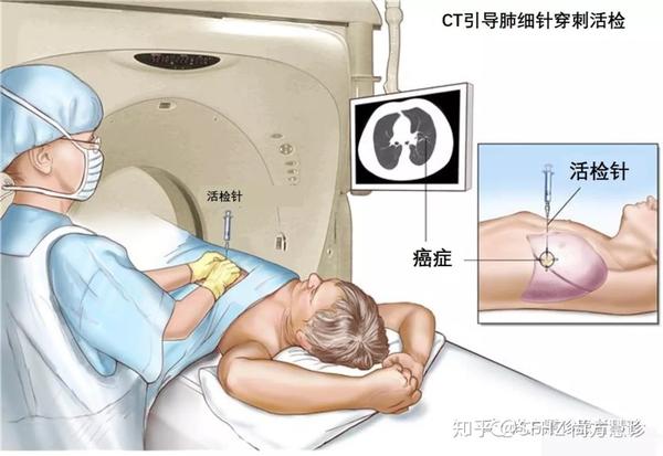 一文读懂肺的穿刺活检