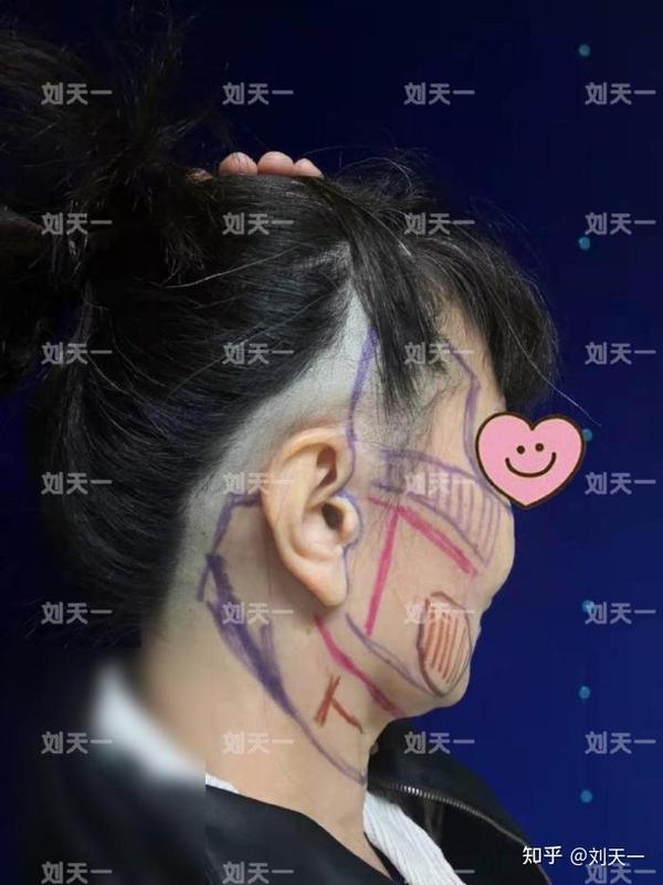 拉皮手术第一次不满意可以做修复吗3