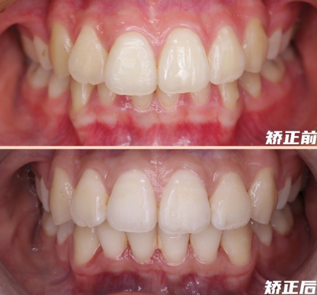 重庆牙齿矫正深覆合不仅影响你的口腔健康还是颜值杀手
