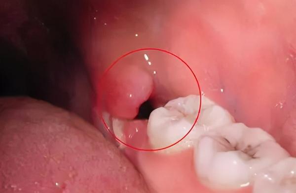 拔牙后创口的止血和愈合恢复,都是依靠您牙齿窝沟里面的凝血块,不让