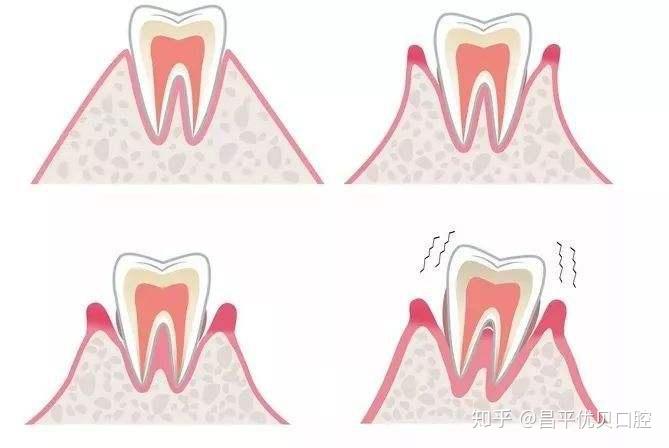 牙周炎是什么?
