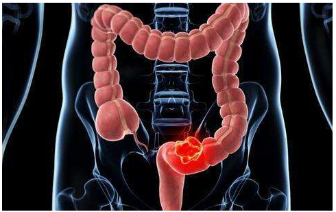 医生提示:这些才是大肠癌的靠谱查法