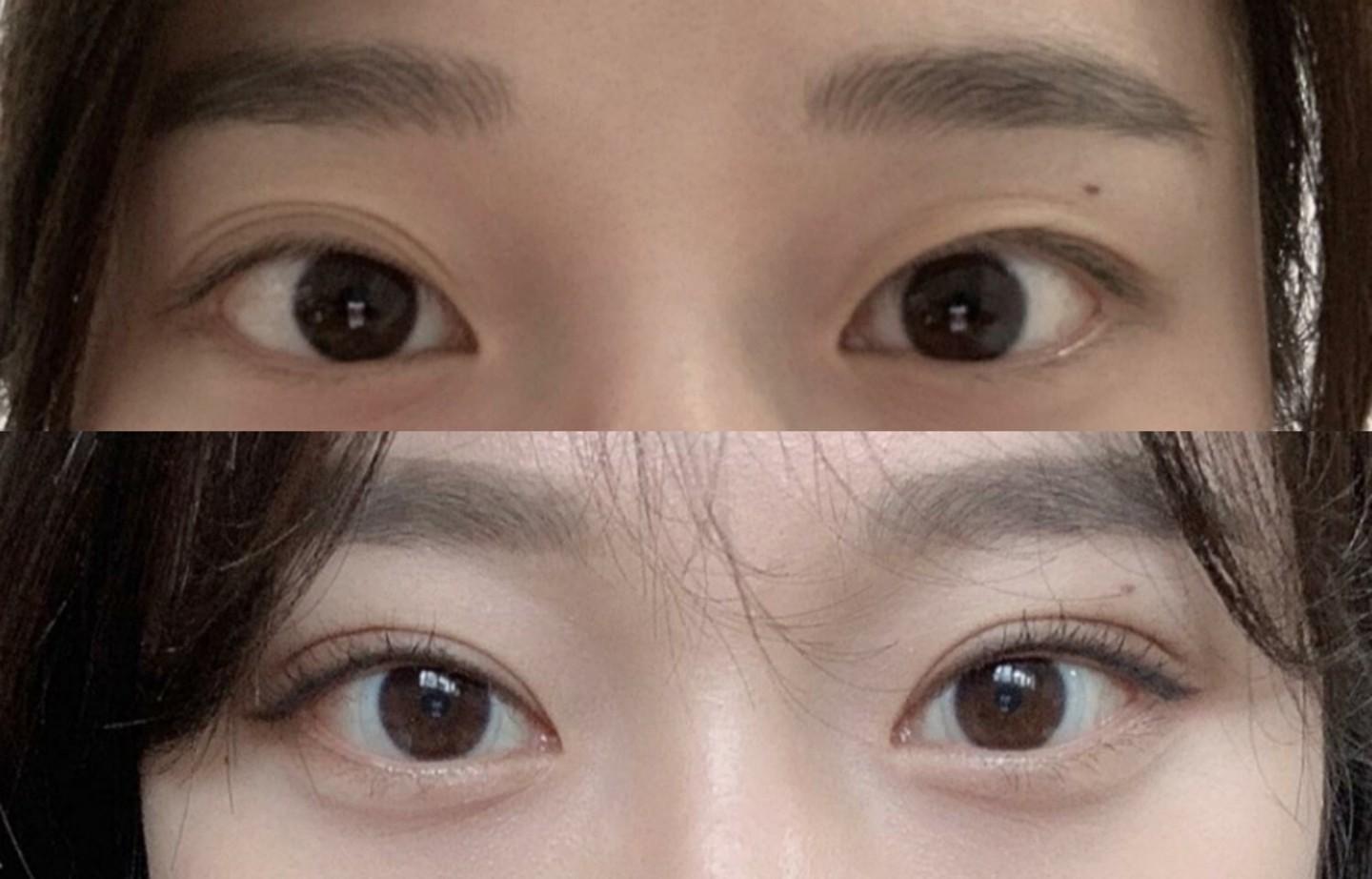 在北京做双眼皮,有好的医院医生推荐吗?割的比较自然那种,大概好多钱?
