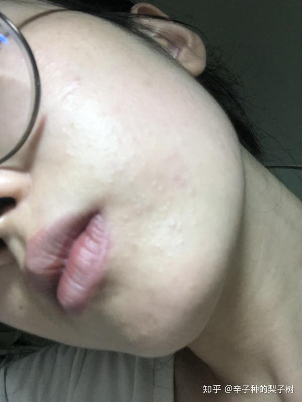 脸上长了很多又红又痒逆光疹子有些透明的尖头看起来油油的脂溢性皮炎