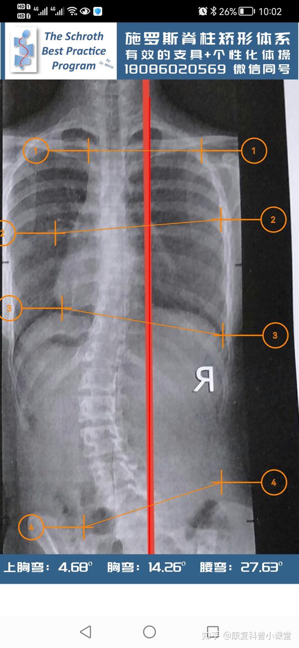 青少年特发性脊柱侧弯病案分享(一)