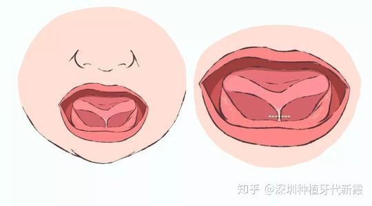 什么是舌系带短这会有什么影响吗该怎么判断舌系带短孩子舌系带过短