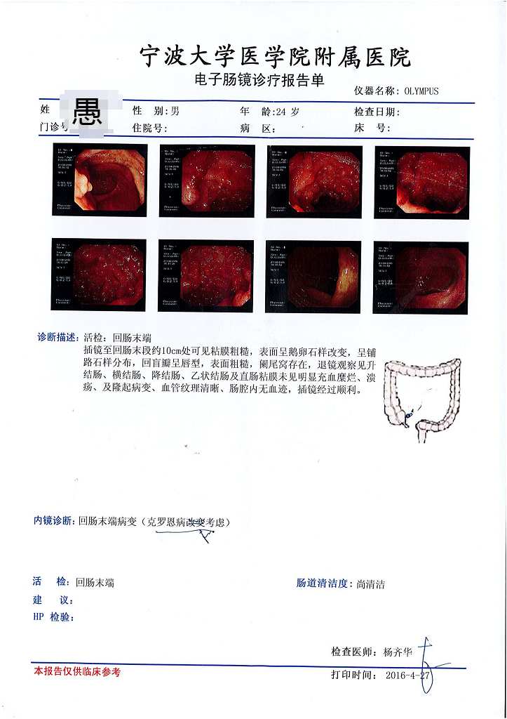 克罗恩病