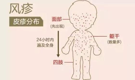 北京疾控提醒您风疹来袭育龄期妇女应特别注意