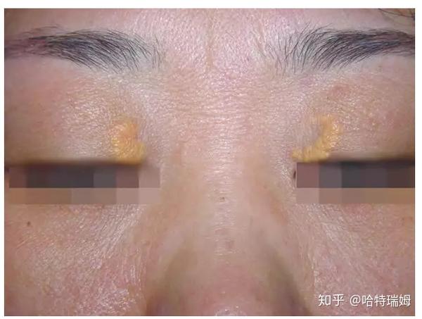 如果您有以下表现,可就要重视了: 01眼皮脂肪瘤 有这种症状通常伴有