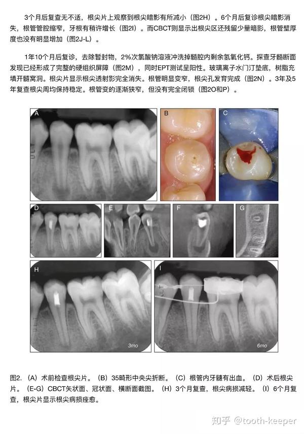 活髓切断治疗年轻恒牙根尖周炎一例