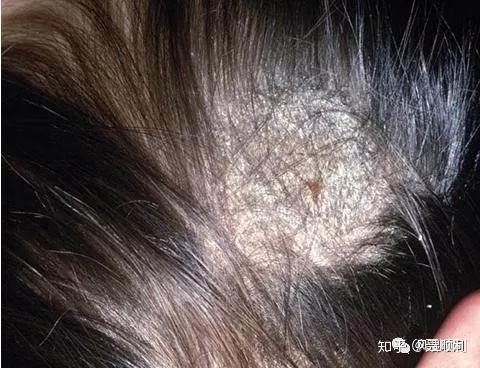 当真菌感染损伤头皮时可导致鳞屑性脱发性斑块.