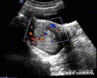 子宫内膜癌超声诊断超声梦影像医生集团ccm