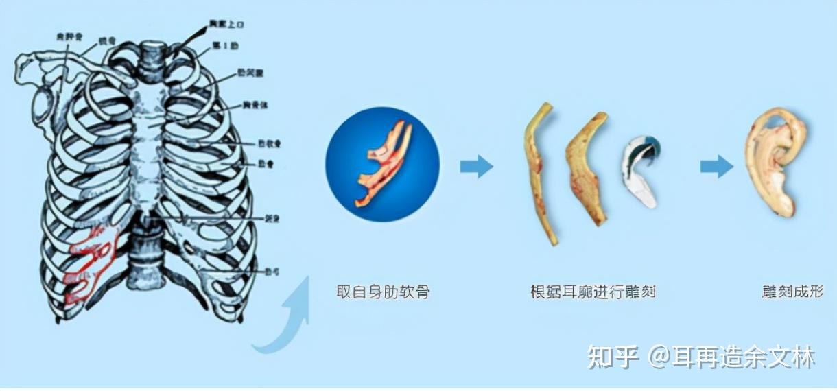 但切一个2~3厘米的皮肤切口,取出三根肋骨远端的软骨(脆骨)对孩子的