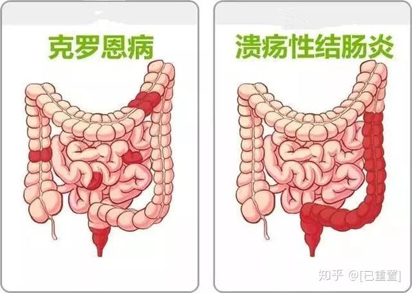 老年溃疡性结肠炎怎么治疗真实病案分析