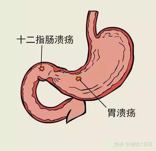 延缓溃疡愈合 甚至造成出血或穿孔 消化性溃疡(pu) 指在各种致病因子