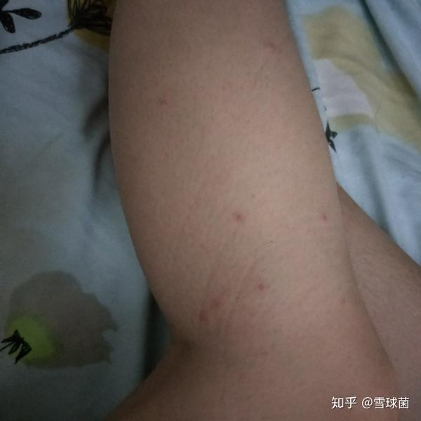 应该是虫子吧,据说肝硬化也长小红点