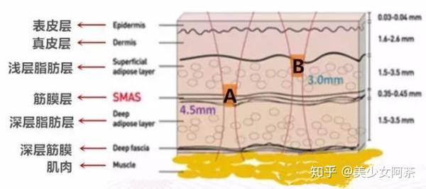 真皮深层,脂肪层, smas层,然后再是肌肉层,因为smas层有足够的张力