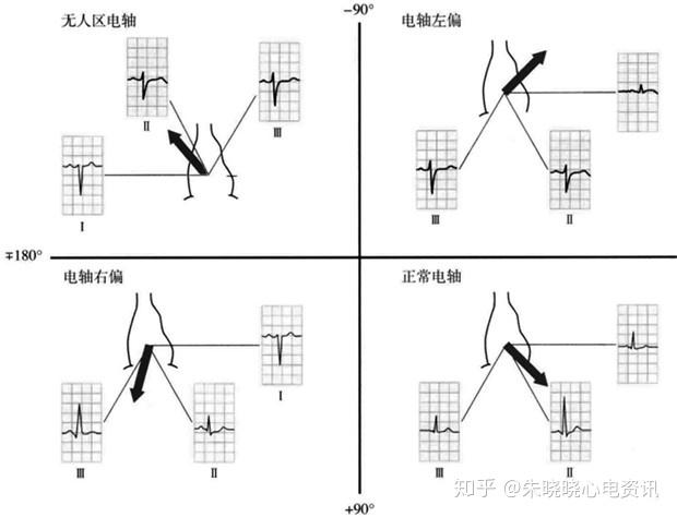 心电轴正常,左偏,右偏及无人区心电轴的示意图