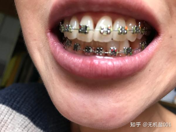 30宝妈龅牙牙龈萎缩牙缝变大后矫正历险记超级害怕牙套脸黑三角法令纹