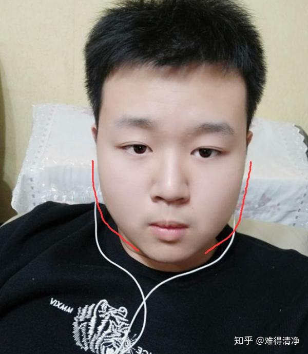 应该是下颌角比较外翻造成的,所以就算你使劲儿减肥,脸上脂肪是可以