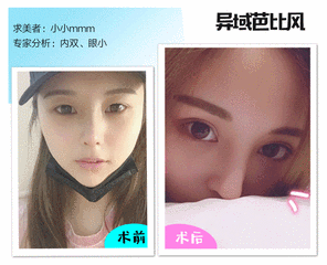 割双眼皮对外貌的改变大吗?