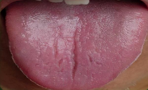 舌绛少苔或无苔,或有裂纹,多属久病阴虚火旺,或热病后期阴液耗损.