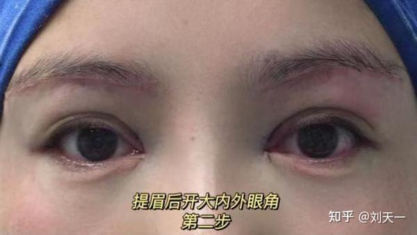 眼皮就要耷拉成三角眼了,我该做什么手术?