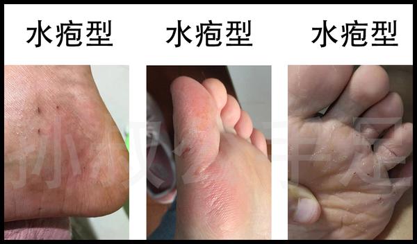 分为表皮层,真皮层,皮下组织,而脚气症状表现就是真菌不断侵蚀皮肤的