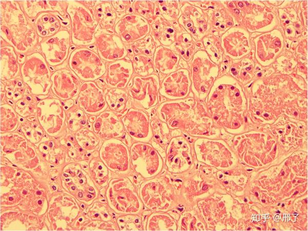 显微镜下表现: 组织学检查发现 – 上皮细胞坍陷 (图1), 细胞萎缩(图2