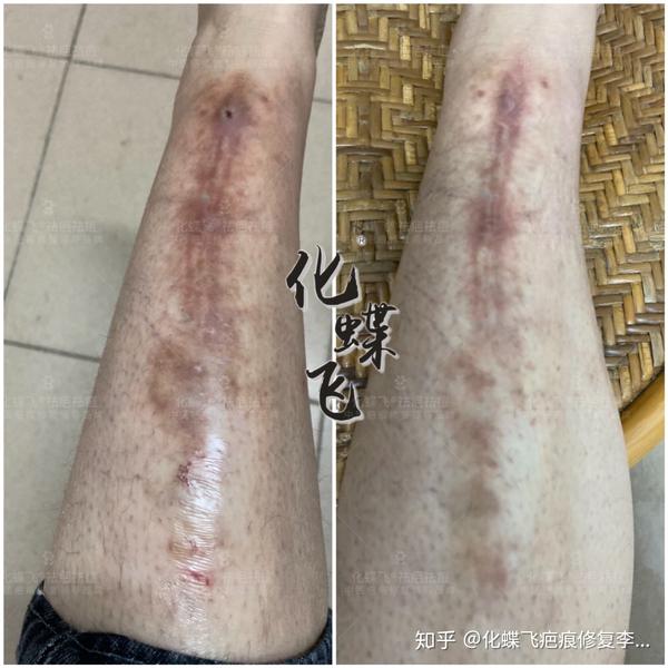 骨折手术疤痕怎么治疗修复?