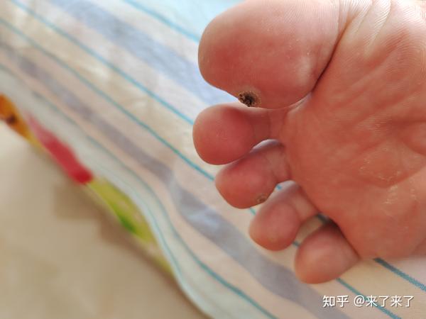 刚冻完没啥反应,我看好多人起了贼大的水泡我这除了疼没啥反应