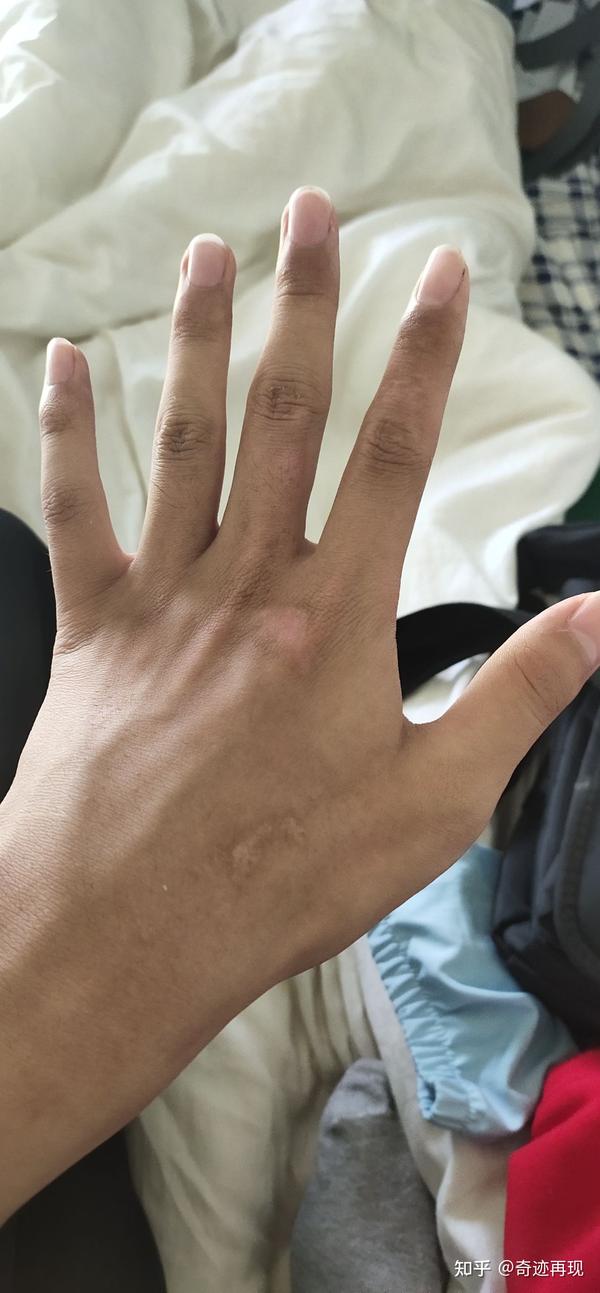 鱼粉烫伤手记录.
