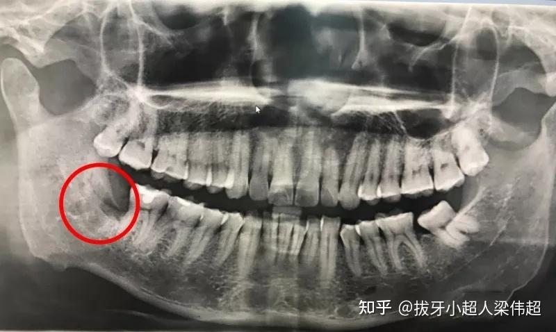 手术过程采用微创拔牙技术,短短二十几分钟就将右下智齿残根彻底拔除