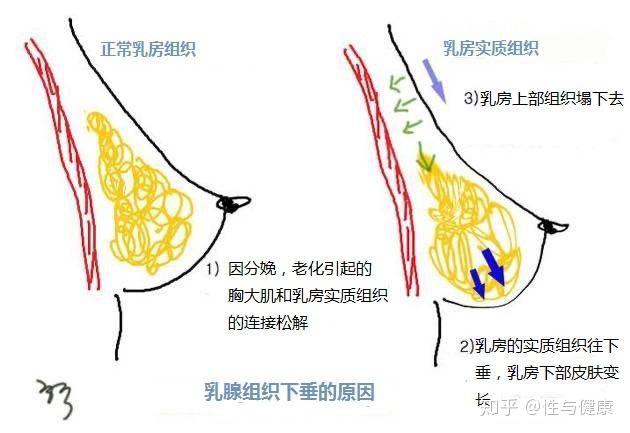 手术要点: ①术前确定乳房应处的正常部位.