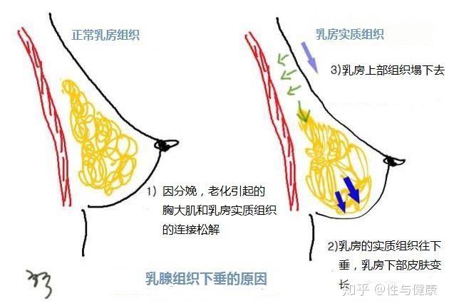 乳头内陷与乳房下垂的一些科普点