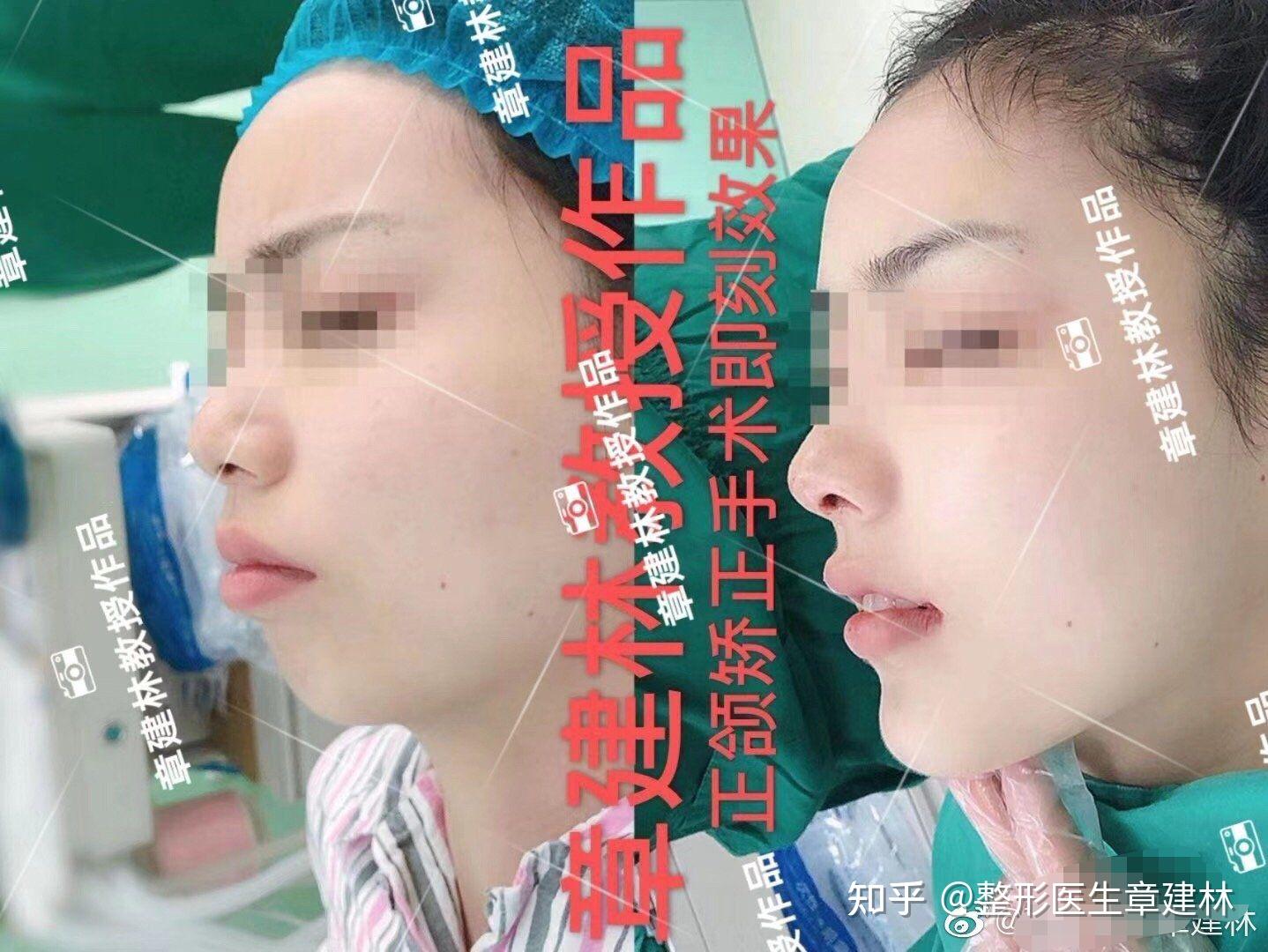 嘴巴凸怎么办